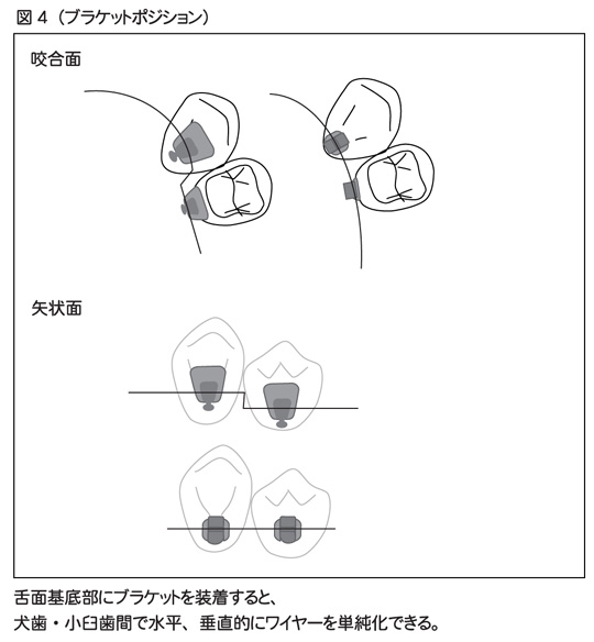 図4 ブラケットポジション