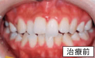 治療前の歯並び